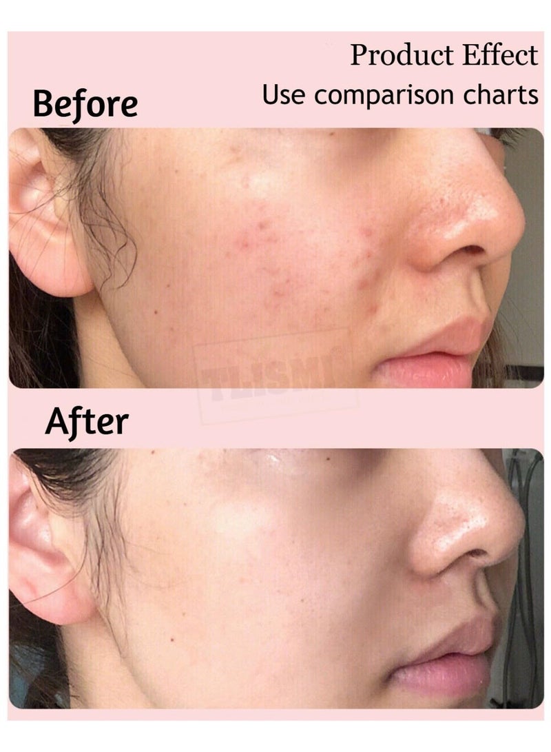 Multi-shaped, transparent, gentle acne patches for the face. Hydrocolloid overnight acne-absorbing patches | Lightweight, waterproof treatment patches for all skin types (24 to 36 patches per pack) - Image 2